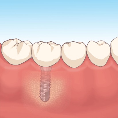 選択肢3 インプラント