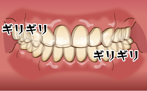 歯ぎしり 顔 でかい