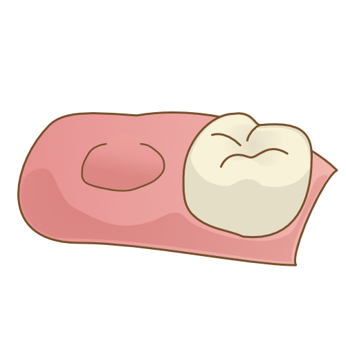 自家歯牙移植